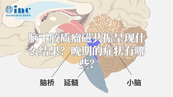 脑干胶质瘤磁共振呈现什么结果？晚期的症状有哪些？