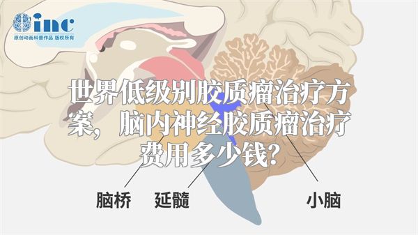 世界低级别胶质瘤治疗方案，脑内神经胶质瘤治疗费用多少钱？