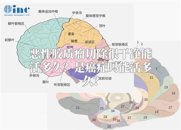 恶性胶质瘤切除很干净能活多久？是癌症吗能活多久？