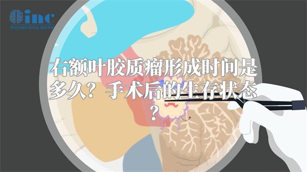 右额叶胶质瘤形成时间是多久？手术后的生存状态？