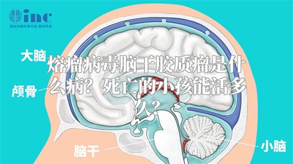 熔瘤病毒脑干胶质瘤是什么病？死亡的小孩能活多久？