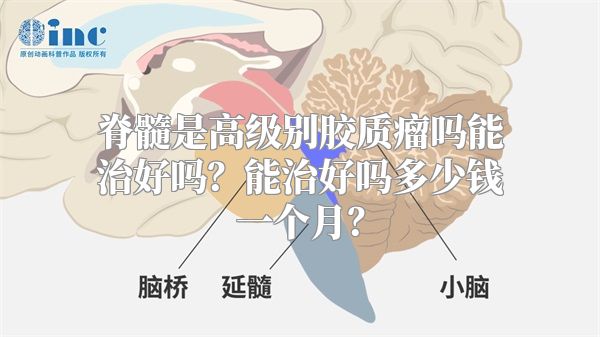 脊髓是高级别胶质瘤吗能治好吗？能治好吗多少钱一个月？