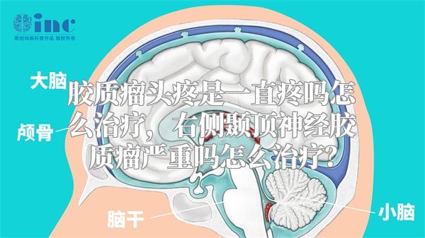 胶质瘤头疼是一直疼吗怎么治疗，右侧颞顶神经胶质瘤严重吗怎么治疗？