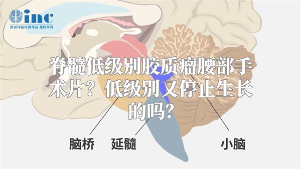 脊髓低级别胶质瘤腰部手术片？低级别又停止生长的吗？