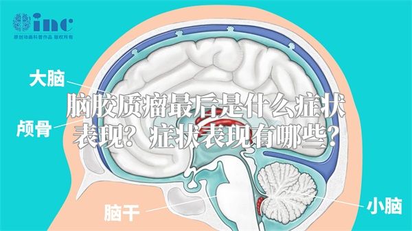 脑胶质瘤最后是什么症状表现？症状表现有哪些？