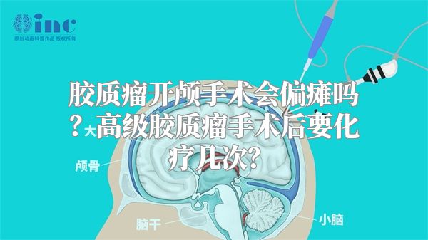 胶质瘤开颅手术会偏瘫吗？高级胶质瘤手术后要化疗几次？