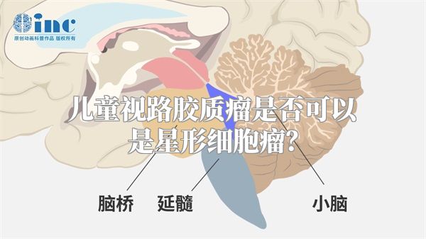 儿童视路胶质瘤是否可以是星形细胞瘤？