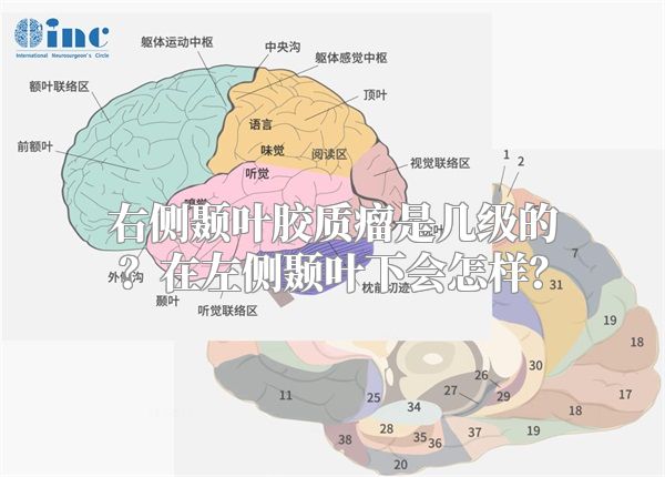 右侧颞叶胶质瘤是几级的？在左侧颞叶下会怎样？