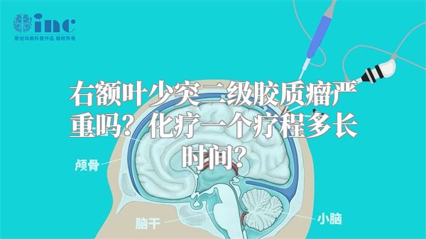 右额叶少突二级胶质瘤严重吗？化疗一个疗程多长时间？