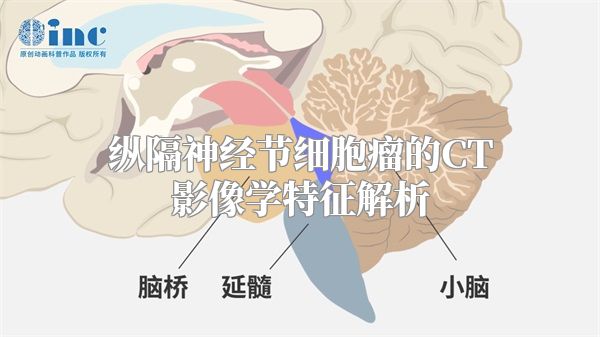 纵隔神经节细胞瘤的CT影像学特征解析