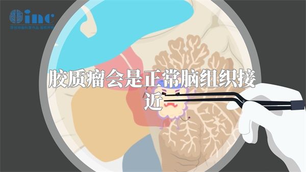 胶质瘤会是正常脑组织接近