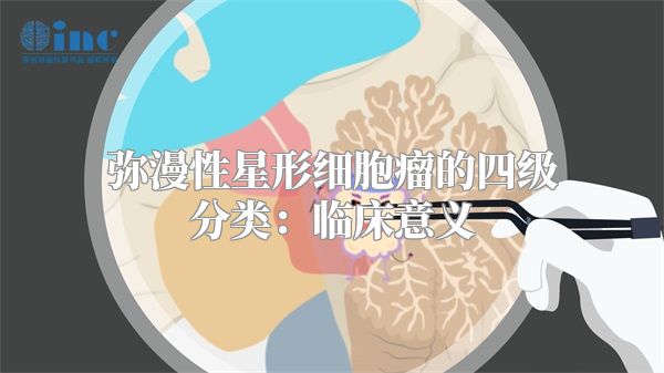 弥漫性星形细胞瘤的四级分类：临床意义