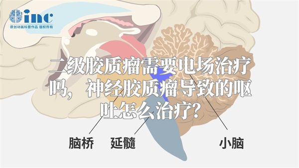 二级胶质瘤需要电场治疗吗，神经胶质瘤导致的呕吐怎么治疗？