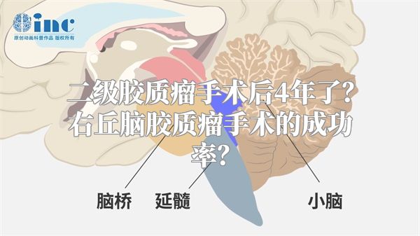 二级胶质瘤手术后4年了？右丘脑胶质瘤手术的成功率？