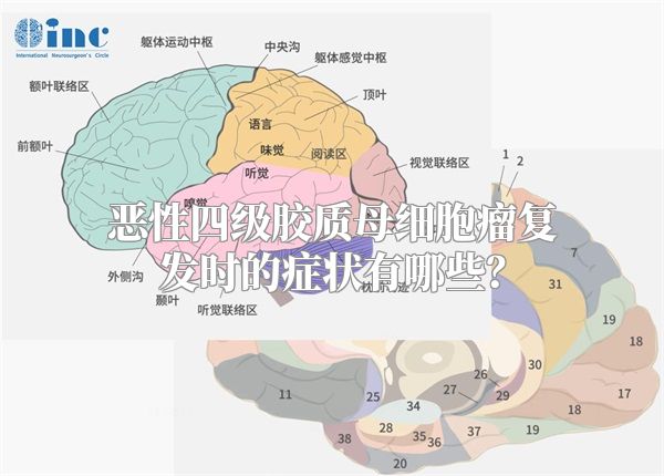 恶性四级胶质母细胞瘤复发时的症状有哪些？