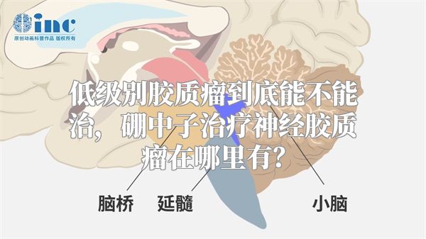 低级别胶质瘤到底能不能治，硼中子治疗神经胶质瘤在哪里有？