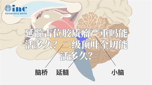 延髓占位胶质瘤严重吗能活多久？二级顶叶全切能活多久？