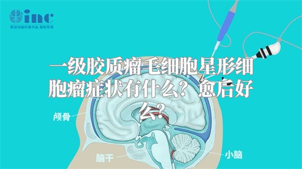 一级胶质瘤毛细胞星形细胞瘤症状有什么？愈后好么？