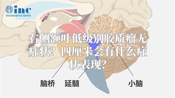 右侧额叶低级别胶质瘤无症状？四厘米会有什么症状表现？