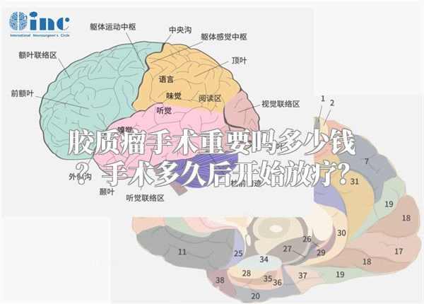 胶质瘤手术重要吗多少钱？手术多久后开始放疗？