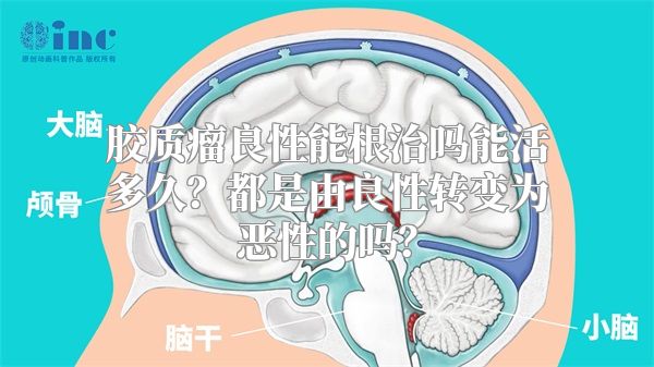 胶质瘤良性能根治吗能活多久？都是由良性转变为恶性的吗？