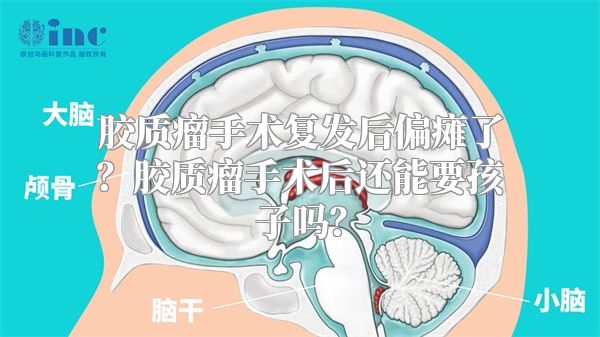 胶质瘤手术复发后偏瘫了？胶质瘤手术后还能要孩子吗？