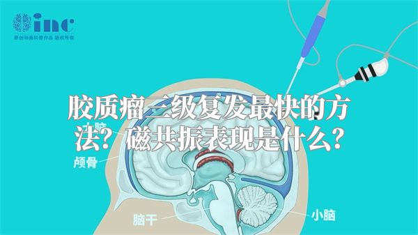 胶质瘤三级复发最快的方法？磁共振表现是什么？