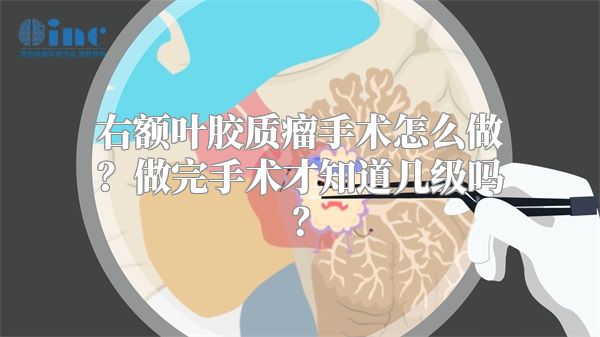 右额叶胶质瘤手术怎么做？做完手术才知道几级吗？