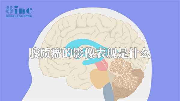 胶质瘤的影像表现是什么