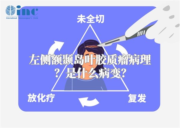 左侧额颞岛叶胶质瘤病理？是什么病变？