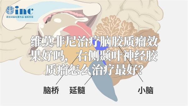 维莫非尼治疗脑胶质瘤效果好吗，右侧颞叶神经胶质瘤怎么治疗最好？