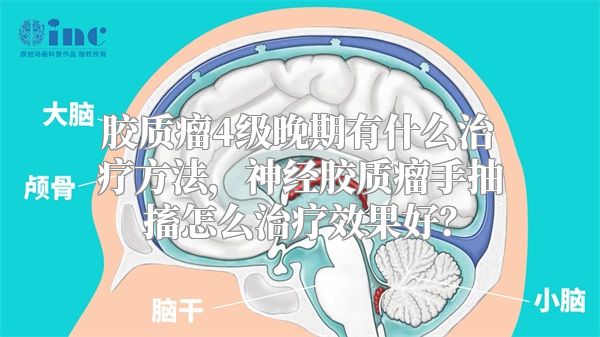 胶质瘤4级晚期有什么治疗方法，神经胶质瘤手抽搐怎么治疗效果好？