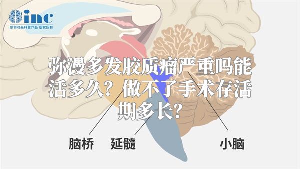 弥漫多发胶质瘤严重吗能活多久？做不了手术存活期多长？