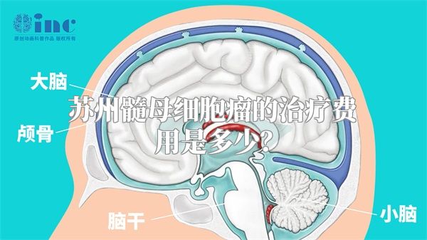 苏州髓母细胞瘤的治疗费用是多少？