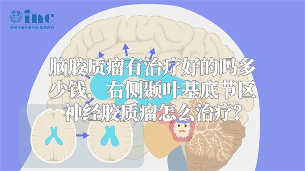 脑胶质瘤有治疗好的吗多少钱，右侧颞叶基底节区神经胶质瘤怎么治疗？