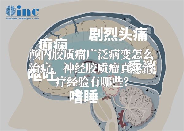 颅内胶质瘤广泛病变怎么治疗，神经胶质瘤真实治疗经验有哪些？