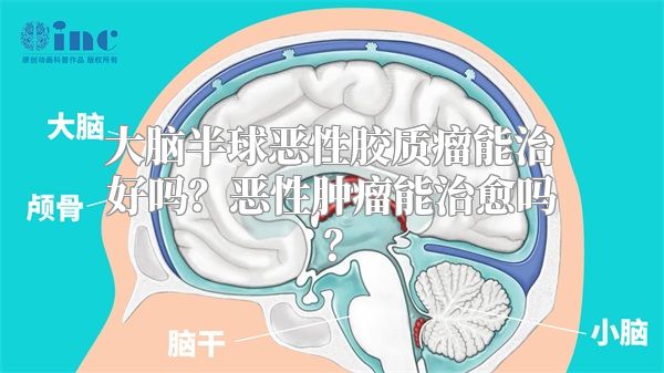 大脑半球恶性胶质瘤能治好吗？恶性肿瘤能治愈吗？