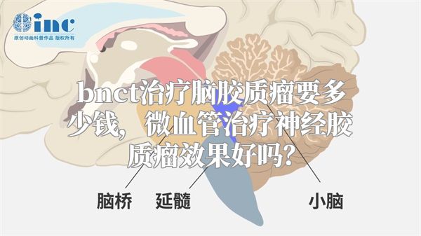 bnct治疗脑胶质瘤要多少钱，微血管治疗神经胶质瘤效果好吗？