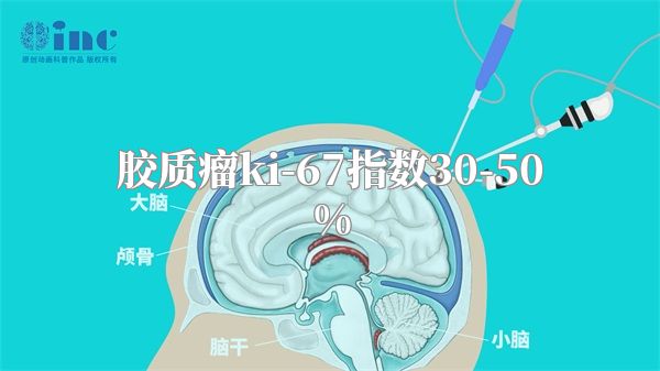 胶质瘤ki-67指数30-50%