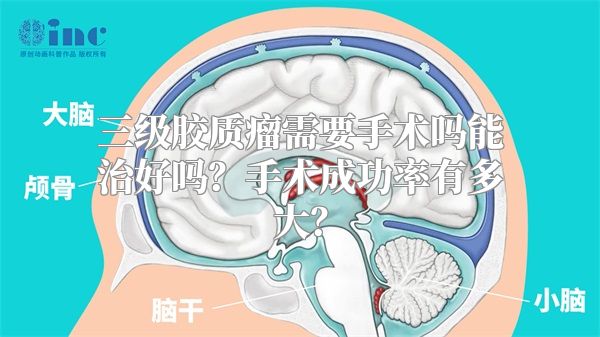 三级胶质瘤需要手术吗能治好吗？手术成功率有多大？