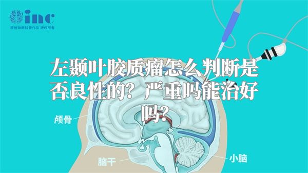 左颞叶胶质瘤怎么判断是否良性的？严重吗能治好吗？