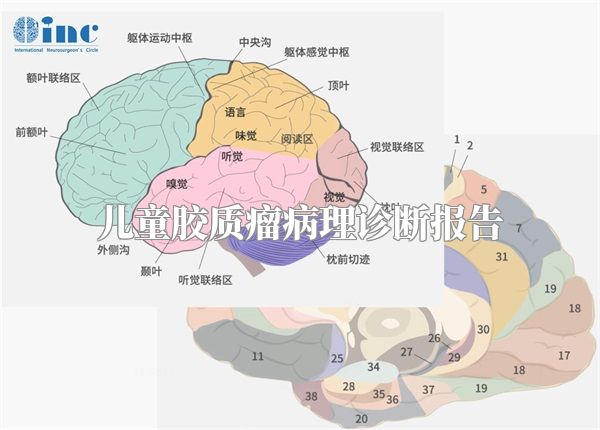 儿童胶质瘤病理诊断报告