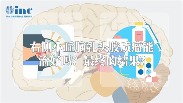 右侧小丘脑乳头胶质瘤能治好吗？最终的结果？