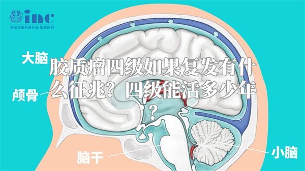 胶质瘤四级如果复发有什么征兆？四级能活多少年？