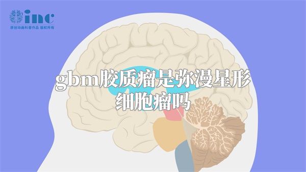 gbm胶质瘤是弥漫星形细胞瘤吗