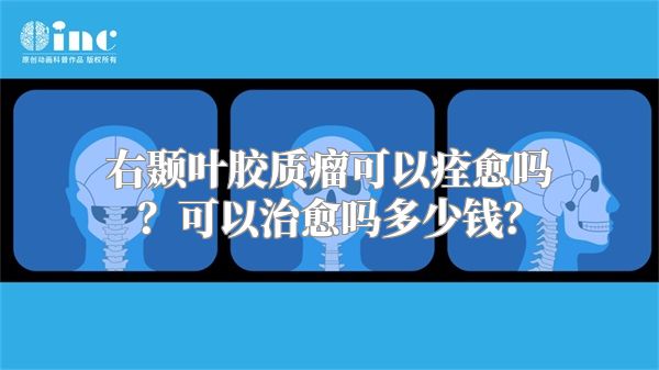 右颞叶胶质瘤可以痊愈吗？可以治愈吗多少钱？