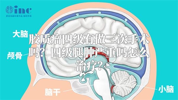 胶质瘤四级有做三次手术吗？四级腿肿严重吗怎么治疗？