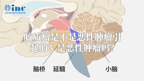 胶质瘤是不是恶性肿瘤引起的？是恶性肿瘤吗？