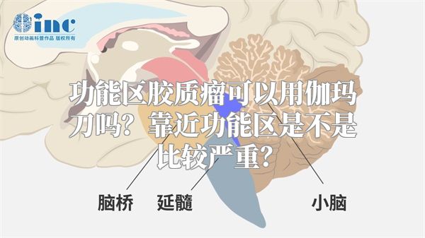 功能区胶质瘤可以用伽玛刀吗？靠近功能区是不是比较严重？