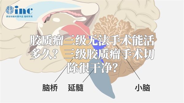 胶质瘤三级无法手术能活多久？三级胶质瘤手术切除很干净？